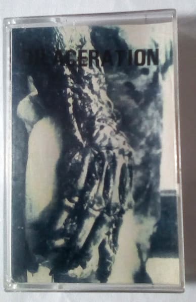 Dilaceration — Dilaceration